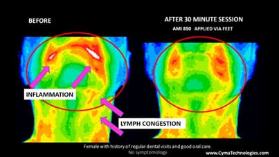 Lymph congestion thermal imaging Many People Ask: Frequently Ask Cymatherapy Questions Vesica Institute for Holistic Studies