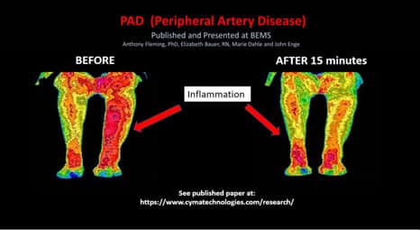 pad peripheral artery disease e1689255009561 Many People Ask: Frequently Ask Cymatherapy Questions Vesica Institute for Holistic Studies