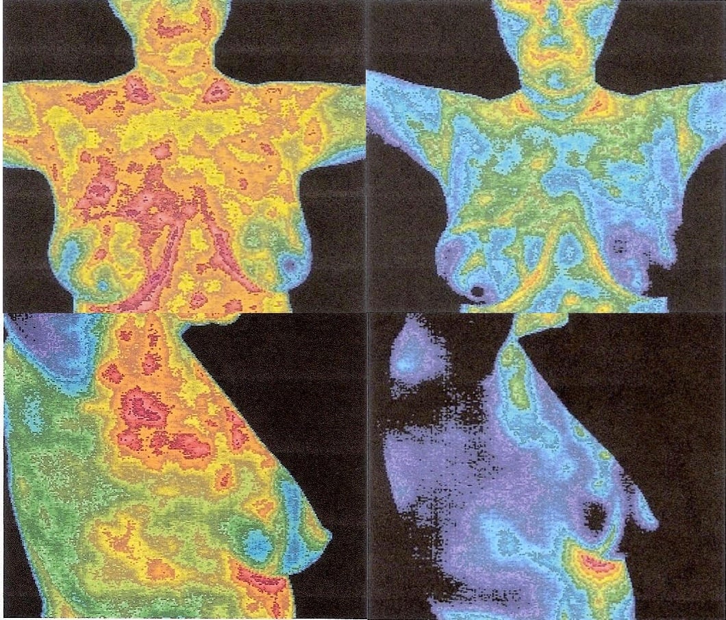 Thermography