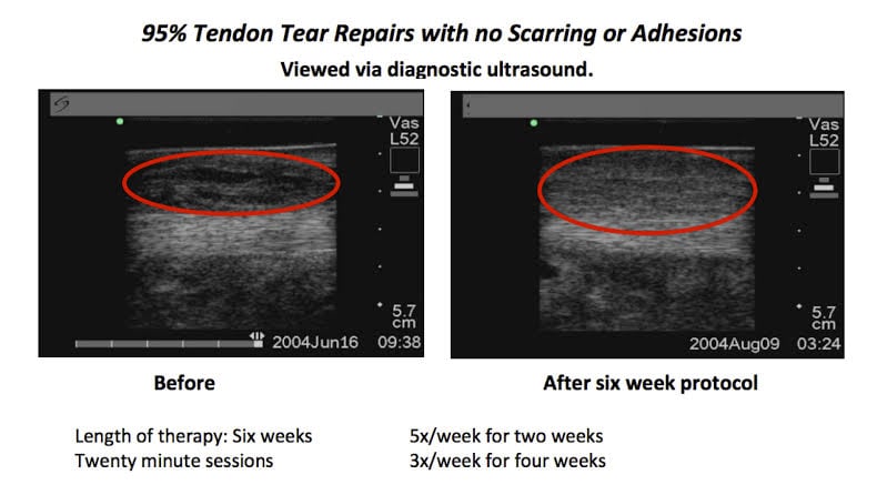 Tendon tear repair