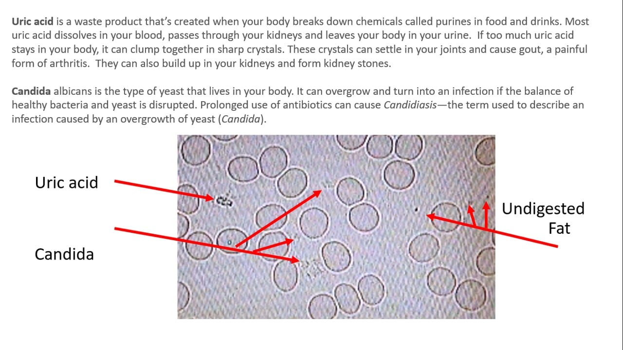 Uric Acid Candida Undigested Fats Recent Report of Live Blood Analysis Results with Cymatherapy Vesica Institute for Holistic Studies